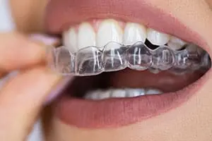 clear aligners