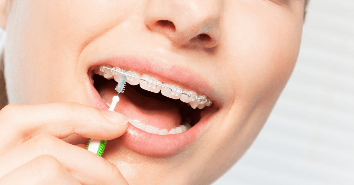 A person uses an interdental brush to clean clear braces, showing a focus on oral hygiene. The close-up highlights clean teeth and careful maintenance.